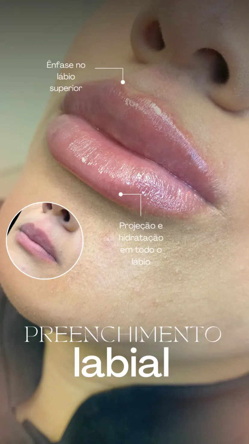 Antes e depois de harmonização facial em Guarulhos