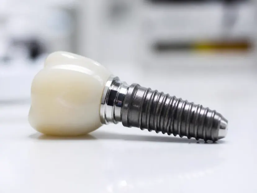 Implante dentário em Guarulhos com Dr. Geraldo Leonel